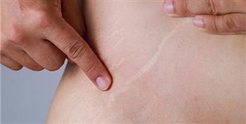 أسباب وطرق علاج تمدد الجلد بعد الحمل والولادة