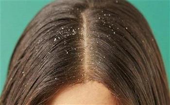 7 نصائح تخلصك من قشرة الشعر المزعجة 