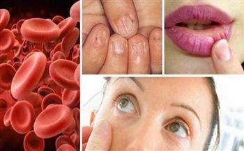 ما هو فقر الدم؟.. تعرف إلى أنواعه وأعراضه