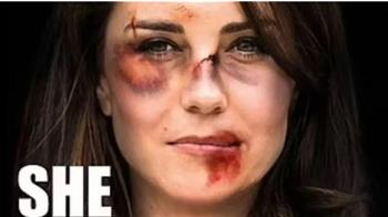 اتهامات للعنف الأسري.. كيت ميدلتون تحتل التريند بإصابات في الوجه