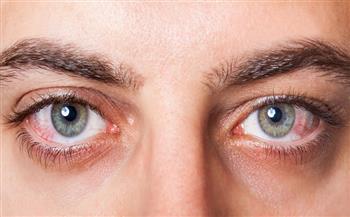 هل إحمرار العين يدل على الإصابة بكورونا؟