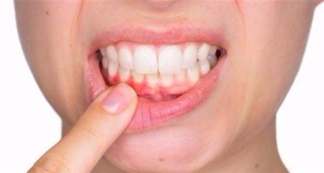 تحييد بروتين تجلط الدم يعمل على منع أمراض اللثة لدى الفئران