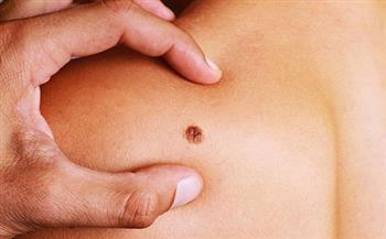 دراسة: استخدام العلاجات الروتينية في منع بعض أنواع سرطان الجلد