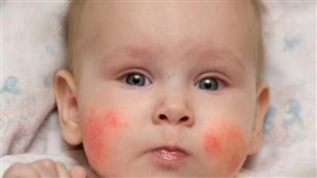حساسية جلد الأطفال.. تعرف على أسبابها وكيفية التعامل معها