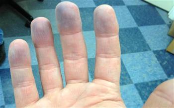 مرض نادر يتسبب في تحول الأصابع إلى اللون الأبيض أو الأزرق