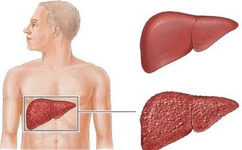 ما هي أعراض وأسباب الالتهاب الكبدي الوبائي "B"؟