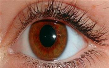 طبيب عيون عن «العشى الليلي»: مرض وراثي ينتُج عن تزاوج الأقارِب