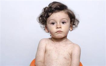 بالاعتماد على التطعيمات.. القضاء على 3 أمراض فيروسية فى مصر