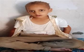 طفلة تتعرض للتنمر بسبب شعرها.. والباز يناشد وزيرة الصحة بعلاجها