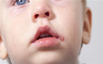 أضرار تقبيل الأطفال من الفم.. يصيبهم فيروس الهربي