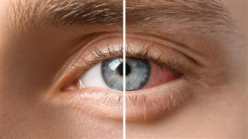 دراسة أمريكية تشير إلى إمكانية ارتباط مشكلات العين بمخاطر أعلى للخرف