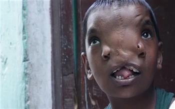 طفلة هندية مولودة بأنفين تتحول إلى إله في الهند لسبب غريب (صور)