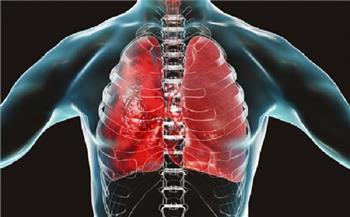 علماء أمريكيون يتوصلون لأسباب الإصابة بسرطان الرئة بين غير المدخنين