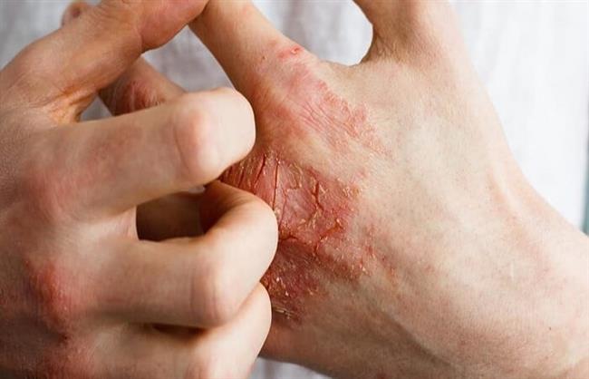 مع برودة الطقس.. 7 نصائح لتجنب ظهور الإكزيما