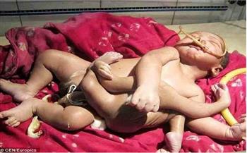 آخر غرائب الهند.. ولادة طفل بـ8 أطراف والآلاف يتوافدون للتبرك به (صور)