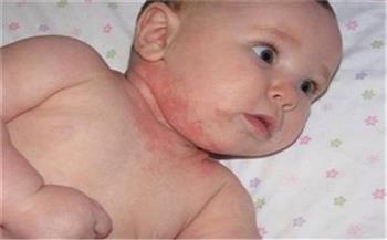 الوقاية منه سهلة ..  "حمو النيل" أشهر الأمراض  على جلد طفلك  