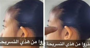 تسبب الصلع .. طبيب يحذر من تسريحة شعر منتشرة بين الفتيات (فيديو)