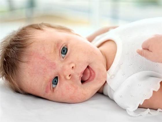 علامات تنذر بحساسية الحليب