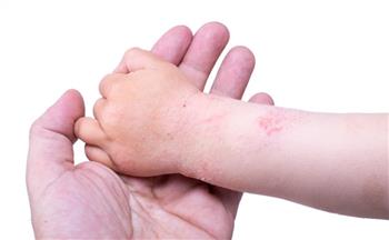 التهاب الجلد والعضلات عند الأطفال 