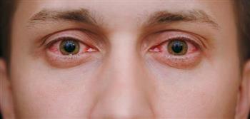 حساسية العين تؤدي إلى ضعف الإبصار