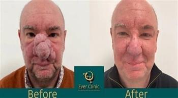شاهد.. اسكتلندي يتخلص من أنفه الضخم بعملية تجميل