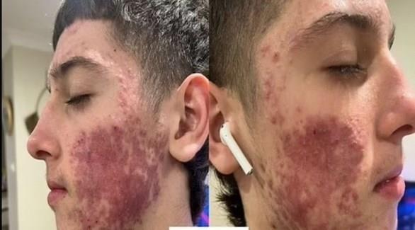 بعلاج طبيعي.. شاب يتخلص من حساسية جلدية شديدة خلال أسابيع