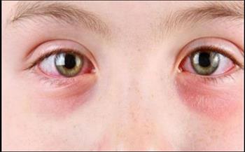 أحد أمراض العين ويقود إلى العمى.. 6 أعراض للإصابة بـ«التراخوما»