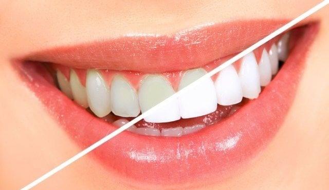  بينها الأدوية والأطعمة السكرية.. 10 أسباب لاصفرار الأسنان