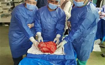 فريق طبي بالمستشفى الجامعي في سوهاج يستأصل ورما يزن 18 كجم من بطن شاب