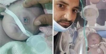واقعة نادرة عالميًا.. ولادة طفل بعين واحدة في هذه الدولة العربية (صور)
