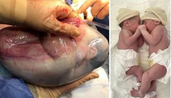 واحدة من 80 ألف حالة.. ولادة توأم «داخل كيس» تثير ذهول الأطباء (صور)