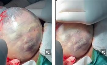 حالة نادرة.. وجه طفل يتحرك داخل الكيس الأمينوسى بعد ولادته (فيديو)