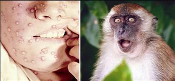 الصحة اللبنانية تنفي وجود حالات مؤكدة أو مشتبه إصابتها بجدري القرود