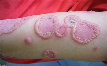 مايكل نصيف: مرض الجلد الفقاعي نادر عالمياً ويسبب قرح وجروح شديدة الألم