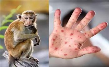 مركز مراقبة الأوبئة الأمريكي يرصد 9 إصابات بجدري القردة في 7 ولايات