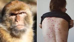 الأرجنتين تسجل أول إصابة بجدري القردة في أمريكا اللاتينية