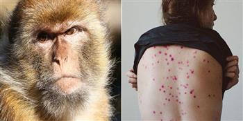 الصحة العالمية: لاخوف من تحول جدري القرود إلى جائحة