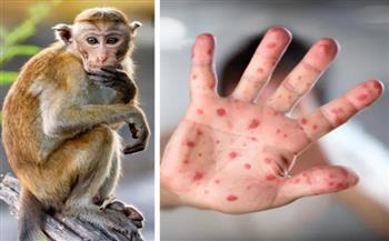 الولاياتُ المتحدةُ ترصدُ 45 إصابةً بجدري القردة