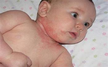 متى تظهر إصابة الطفل بحساسية الألبان؟.. «الصحة» تجيب