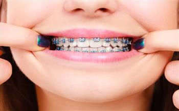 الفوائد العشر لتقويم الأسنان