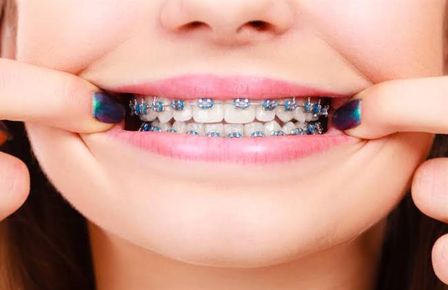 الفوائد العشر لتقويم الأسنان