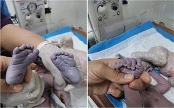 حالة نادرة جدا.. عراقية تضع مولودا به 24 إصبعا(صور)