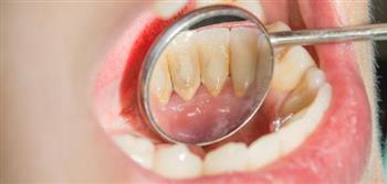 بينها الأمراض والوراثة.. 10 أسباب لإصفرار الأسنان