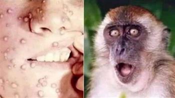 تسجيل أول حالة إصابة مؤكدة بجدري القردة في اليابان