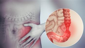 دراسة جديدة: التهاب الأمعاء المزمن قد يكون مرتبطا بالبدانة