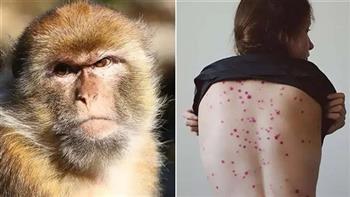 إندونيسيا تسجل أول حالة إصابة مؤكدة بجدري القرود