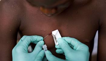 البحرين تعلن فتح باب التسجيل المُسبق للتطعيم الاختياري المضاد لجدري القردة