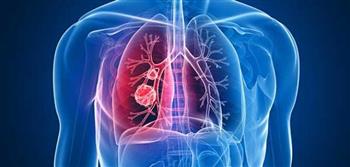 علماء يكتشفون كيفية تسبب تلوث الهواء في إصابة غير المدخنين بسرطان الرئة
