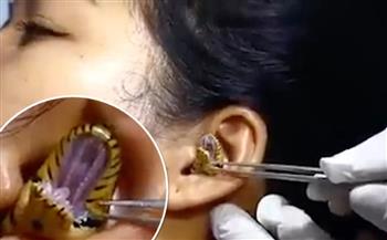 طريقة دخوله غير معروفة.. لحظة استخراج ثعبان حيّ من أذن هندية (فيديو)