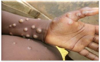 السودان يسجل 5 إصابات جديدة بجدري القردة في 4 ولايات
